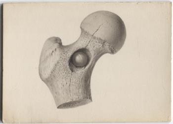 BONE, femur, upper end